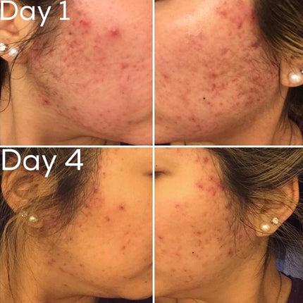 3-Step Acne System